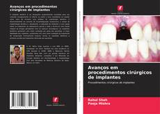 Bookcover of Avanços em procedimentos cirúrgicos de implantes