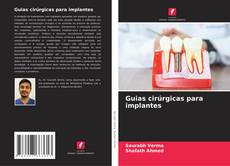 Bookcover of Guias cirúrgicas para implantes