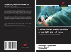 Buchcover von Comparison of adenocarcinoma of the right and left colon