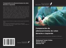 Comparación de adenocarcinoma de colon derecho e izquierdo的封面
