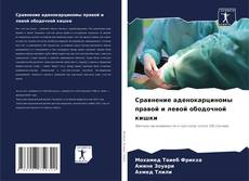 Bookcover of Сравнение аденокарциномы правой и левой ободочной кишки