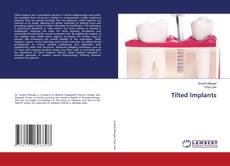 Copertina di Tilted Implants