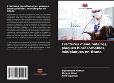 Fractures mandibulaires, plaques biorésorbables, miniplaques en titane kitap kapağı