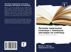 Buchcover von Лечение переломов ключицы с помощью накладок на ключицу