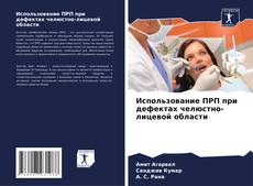 Buchcover von Использование ПРП при дефектах челюстно-лицевой области