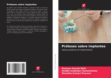 Couverture de Próteses sobre implantes