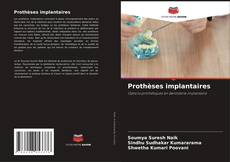 Bookcover of Prothèses implantaires