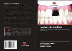 Bookcover of Implants immédiats