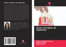 Couverture de Guias cirúrgicos de implantes