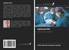 Copertina di Liposucción