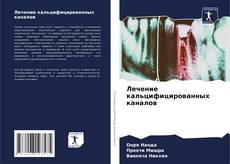 Лечение кальцифицированных каналов的封面