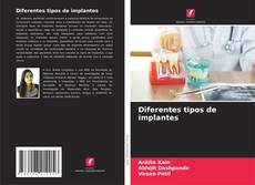 Buchcover von Diferentes tipos de implantes