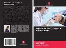 Bookcover of Implantes em crianças e adolescentes