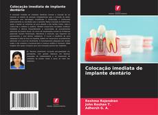 Couverture de Colocação imediata de implante dentário