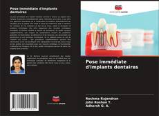 Couverture de Pose immédiate d'implants dentaires