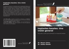 Buchcover von Implantes basales: Una visión general