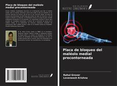 Buchcover von Placa de bloqueo del maléolo medial precontorneada