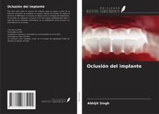 Buchcover von Oclusión del implante