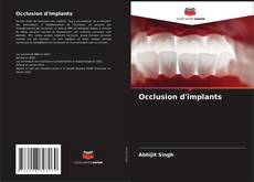 Bookcover of Occlusion d'implants