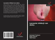 Bookcover of Leczenie infekcji ran skóry