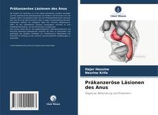 Präkanzeröse Läsionen des Anus的封面
