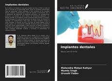 Borítókép a  Implantes dentales - hoz