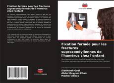 Обложка Fixation fermée pour les fractures supracondyliennes de l'humérus chez l'enfant