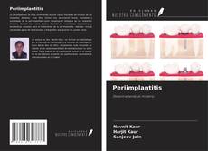 Copertina di Periimplantitis