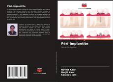 Couverture de Péri-implantite