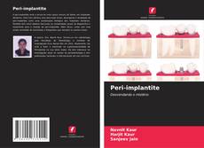 Обложка Peri-implantite