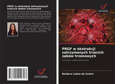 Portada del libro de PRGF w ekstrakcji zatrzymanych trzecich zębów trzonowych