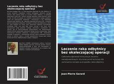 Couverture de Leczenie raka odbytnicy bez okaleczającej operacji