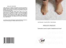 Couverture de HALLUX VALGUS