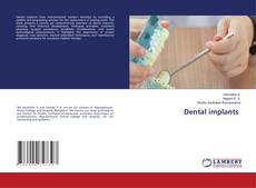 Bookcover of Dental implants