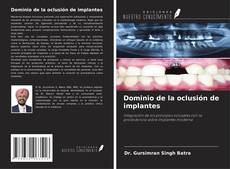 Couverture de Dominio de la oclusión de implantes