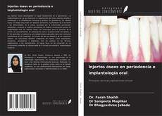 Copertina di Injertos óseos en periodoncia e implantología oral
