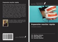 Bookcover of Expansión maxilar rápida