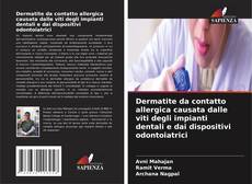 Copertina di Dermatite da contatto allergica causata dalle viti degli impianti dentali e dai dispositivi odontoiatrici