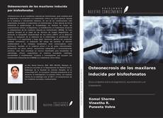 Osteonecrosis de los maxilares inducida por bisfosfonatos的封面