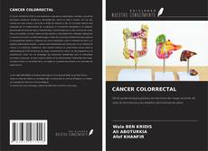 Bookcover of CÁNCER COLORRECTAL
