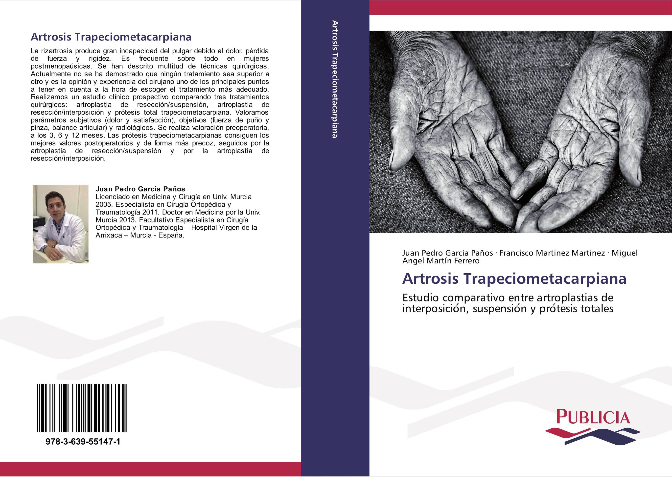 Artrosis Trapeciometacarpiana