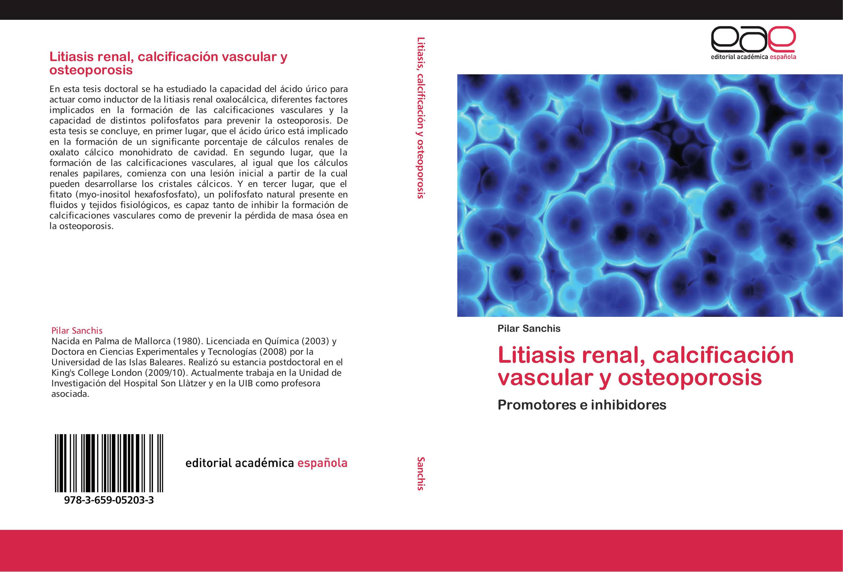 Litiasis renal, calcificación vascular y osteoporosis