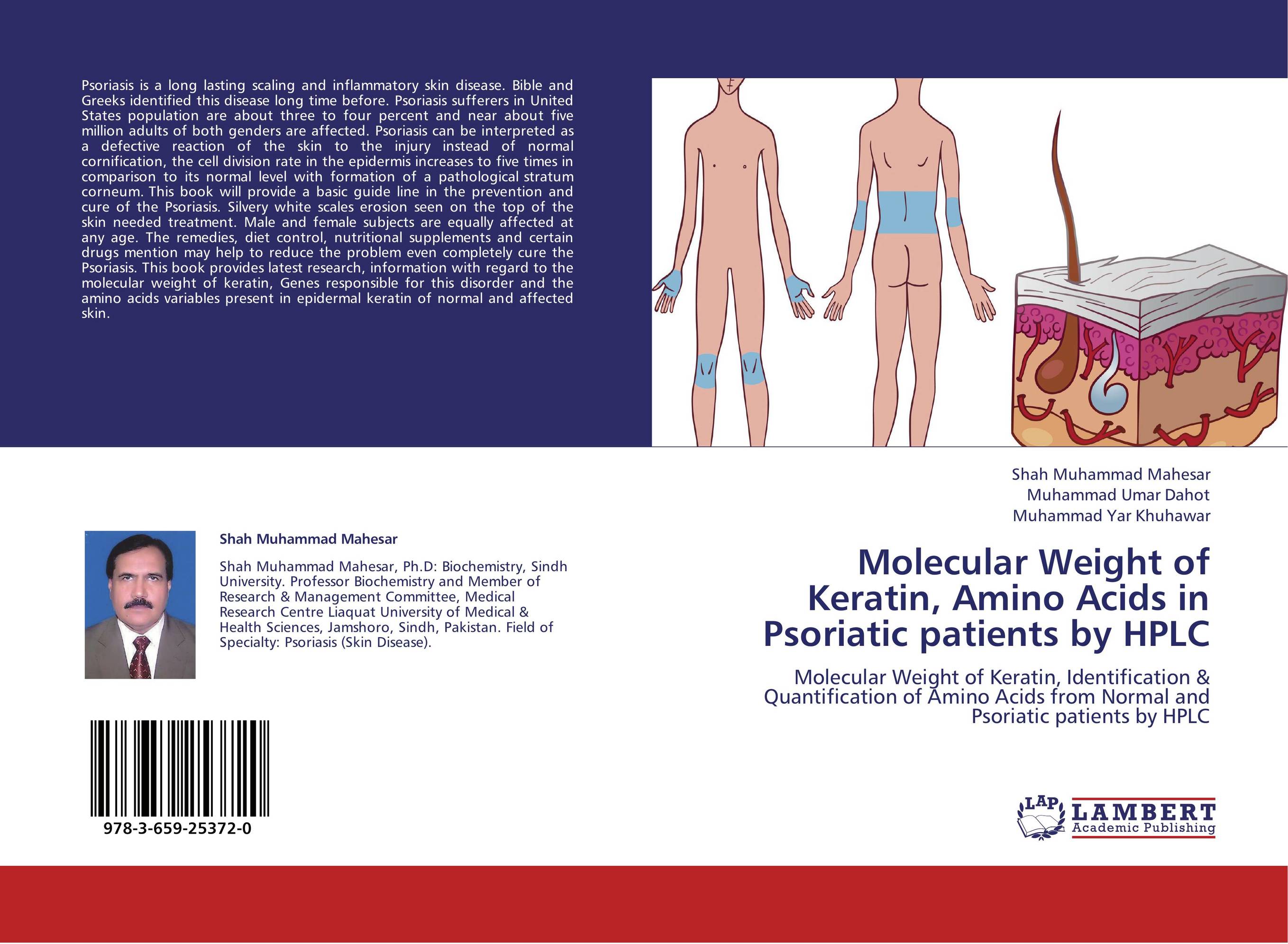 Molecular Weight of Keratin, Amino Acids in Psoriatic patients by HPLC. Molecular Weight of Keratin, Identification &amp;amp; Quantification of Amino Acids from Normal and Psoriatic patients by HPLC.