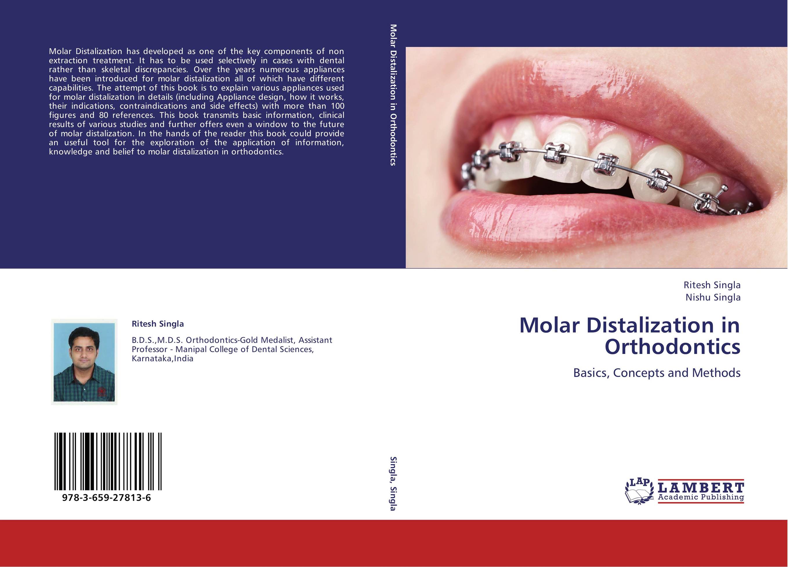 Molar Distalization in Orthodontics. Basics, Concepts and Methods.