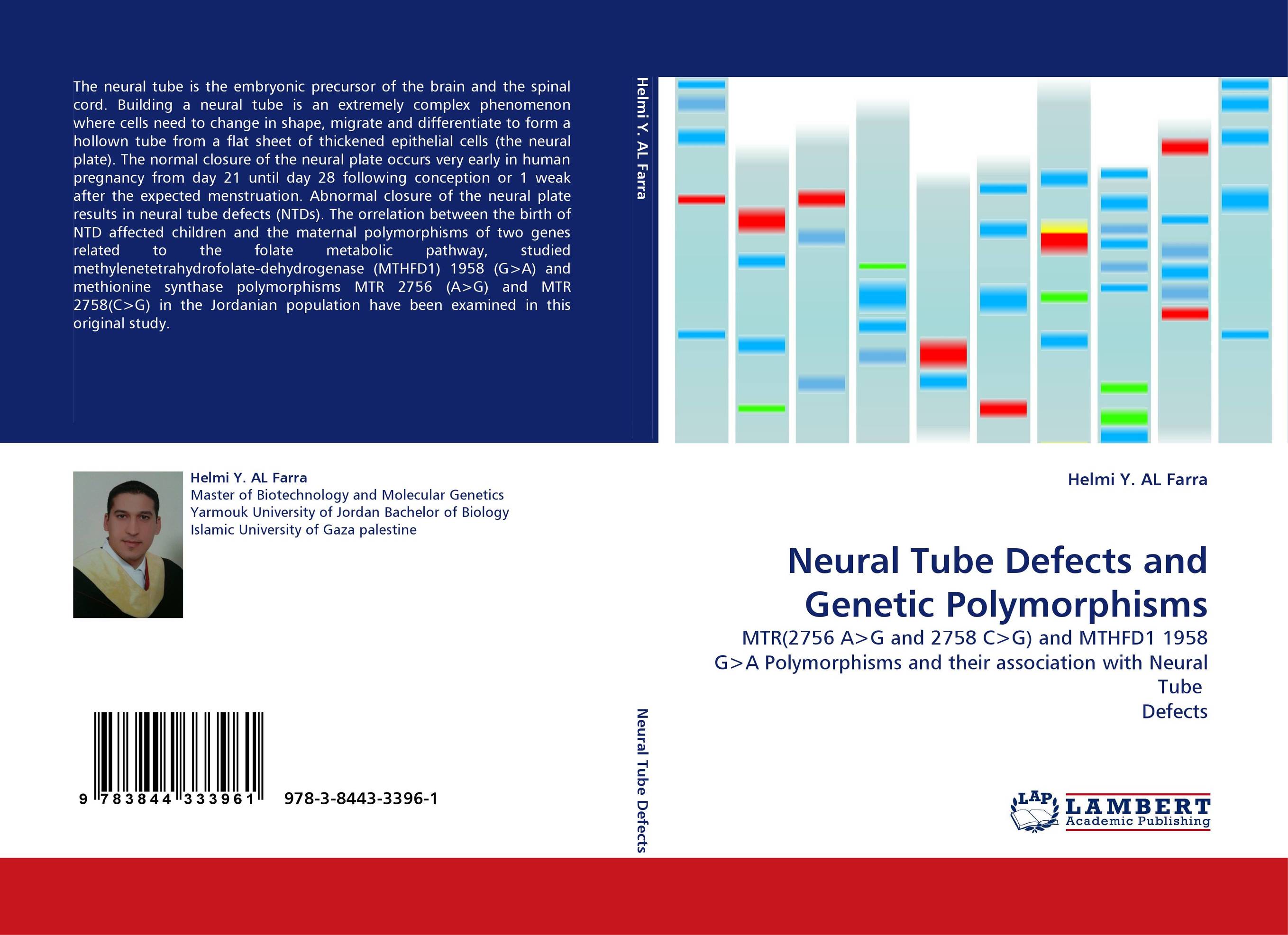 Neural Tube Defects and Genetic Polymorphisms. MTR(2756 A&amp;gt;G and 2758 C&amp;gt;G) and MTHFD1 1958 G&amp;gt;A Polymorphisms and their association with Neural Tube  Defects.