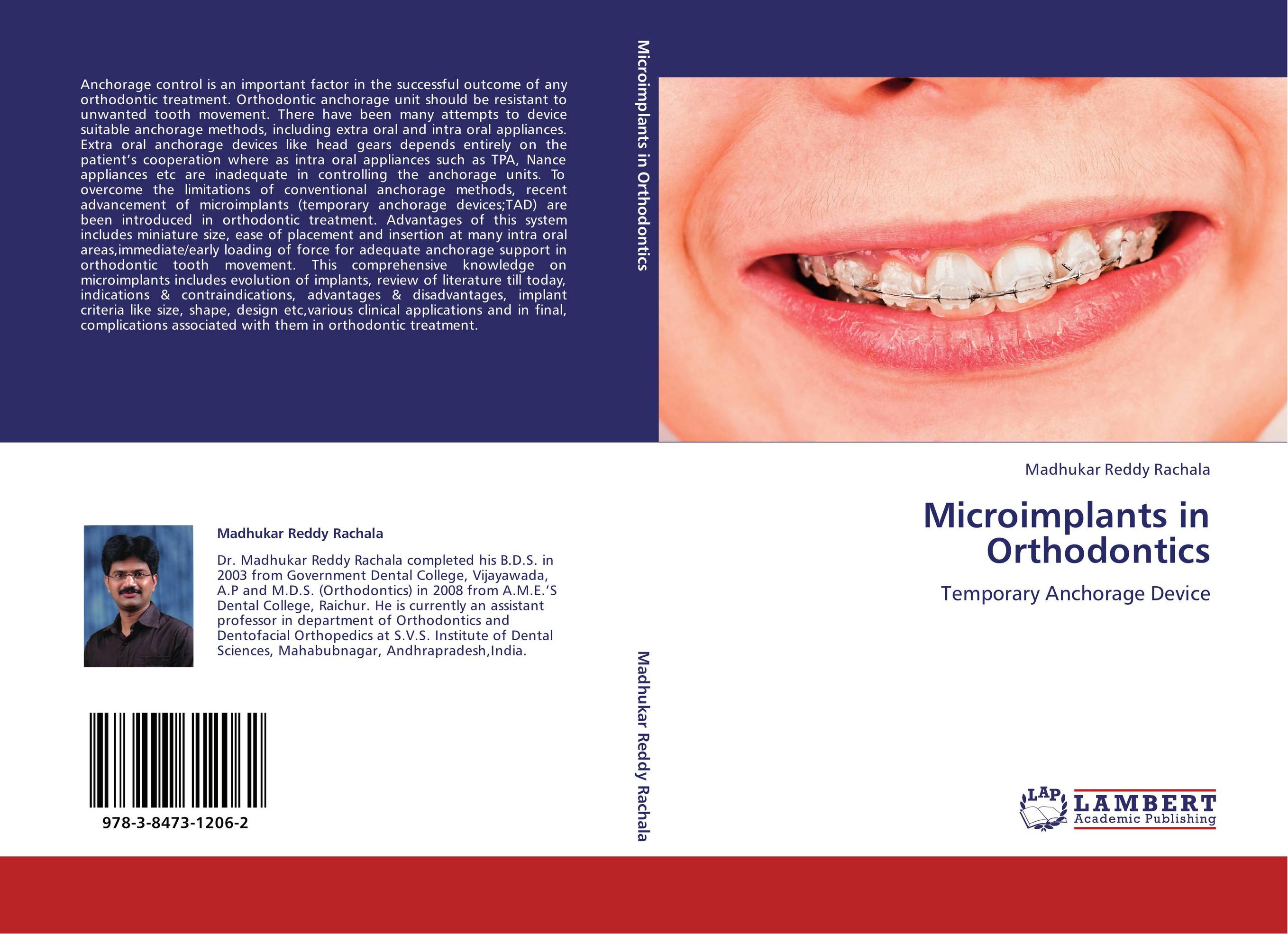Microimplants in Orthodontics. Temporary Anchorage Device.