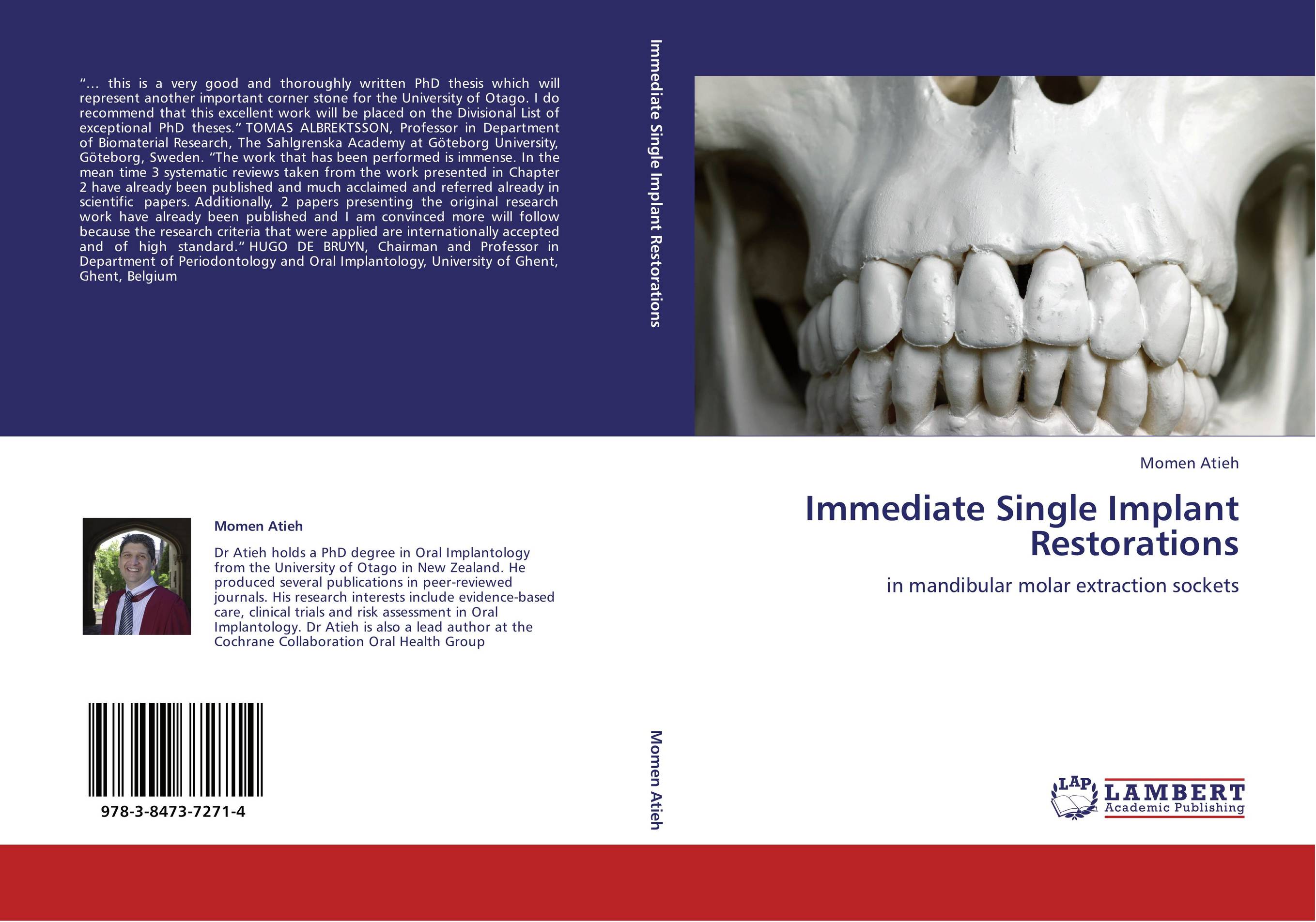 Immediate Single Implant Restorations. In mandibular molar extraction sockets.